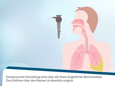 Darstellung, wie das Bronchoskop bei der Bronchoskopie für eine Lungenbiopsie eingeführt wird.