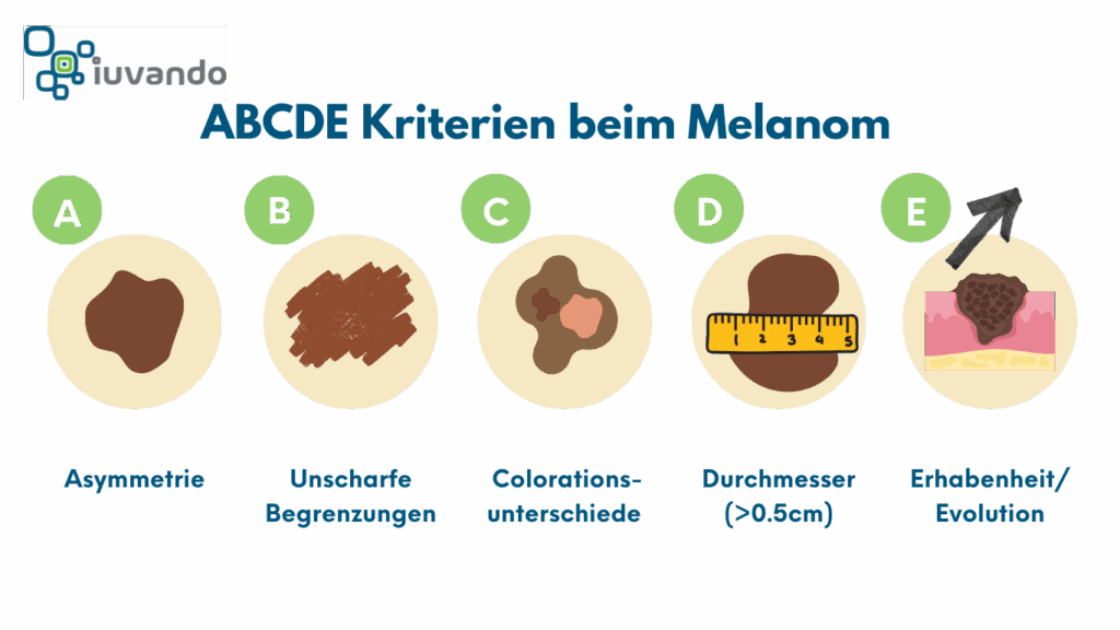 Die ABCDE Kriterien beim Melanom als Schaubild