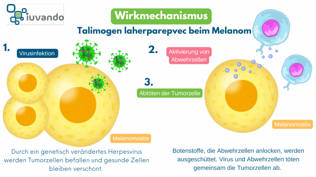 Schematische Darstellung des Wirkmechanismus von Talimogen Laherparepvec beim kutanen Meanom